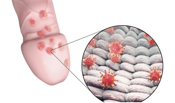 péniszbővítő gél allergia